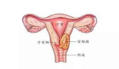 子宫癌：女性生殖系统的“信号灯”，早发现是关键